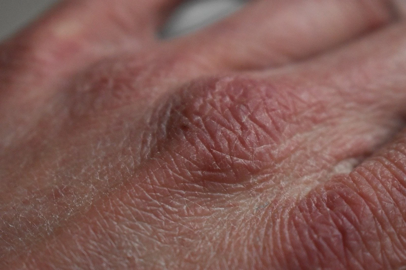 Dehydration and pain relief